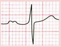 5: Normální průběh P vlny Je-li vlna P přítomna a je-li v pravidelných vzdálenostech vždy následována QRS komplexem, většinou se jedná o sinusový rytmus. Stačí najít vlny P alespoň v jednom ze svodů.