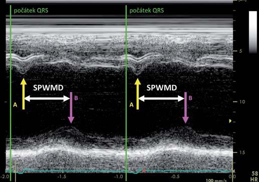 368 Echokardiografie a srdeční resynchronizační léčba k hodnocení intraventrikulární dyssynchronie s nadějnými výsledky prací publikovaných z jednotlivých expertních center (obr. 3) [21,22]. Obr.