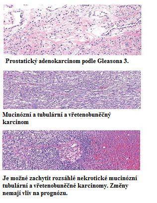 Stručný popis jednotlivých markerů karcinomu prostaty PSA (prostatický specifický antigen), fpsa (volná frakce PSA) Wang a jeho spolupracovníci identifikovali a vyčistili prostatický specifický