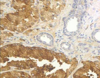 [-2]ProPSA jako specifičtější marker pro Ca Prostaty Normální žláza Nádorová tkáň Mikolajczyk et al Cancer Research 2001; 61: 6958 6963 Nejvíce pozornosti se věnuje [-2]proPSA, protože jde o primární