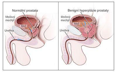 Růst BHP charakterizuje tvorba uzlů, difúzní hyperplázie tranzientní zóny a zvětšování uzlů. Okolní prostatická tkáň je pomalu posouvána periferně a tvoří tzv. chirurgické pouzdro.