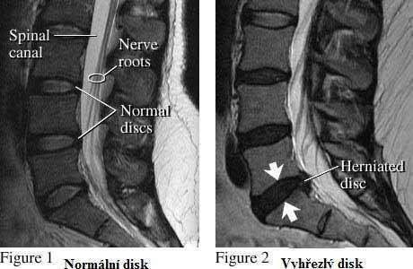 MRI (obr. č. 4) hlavní rozdíl oproti CT spočívá v tom, že místo rentgenového záření se při magnetické rezonanci uplatňují radiofrekvenční pulzy. Pacient tak není vystaven škodlivému záření.
