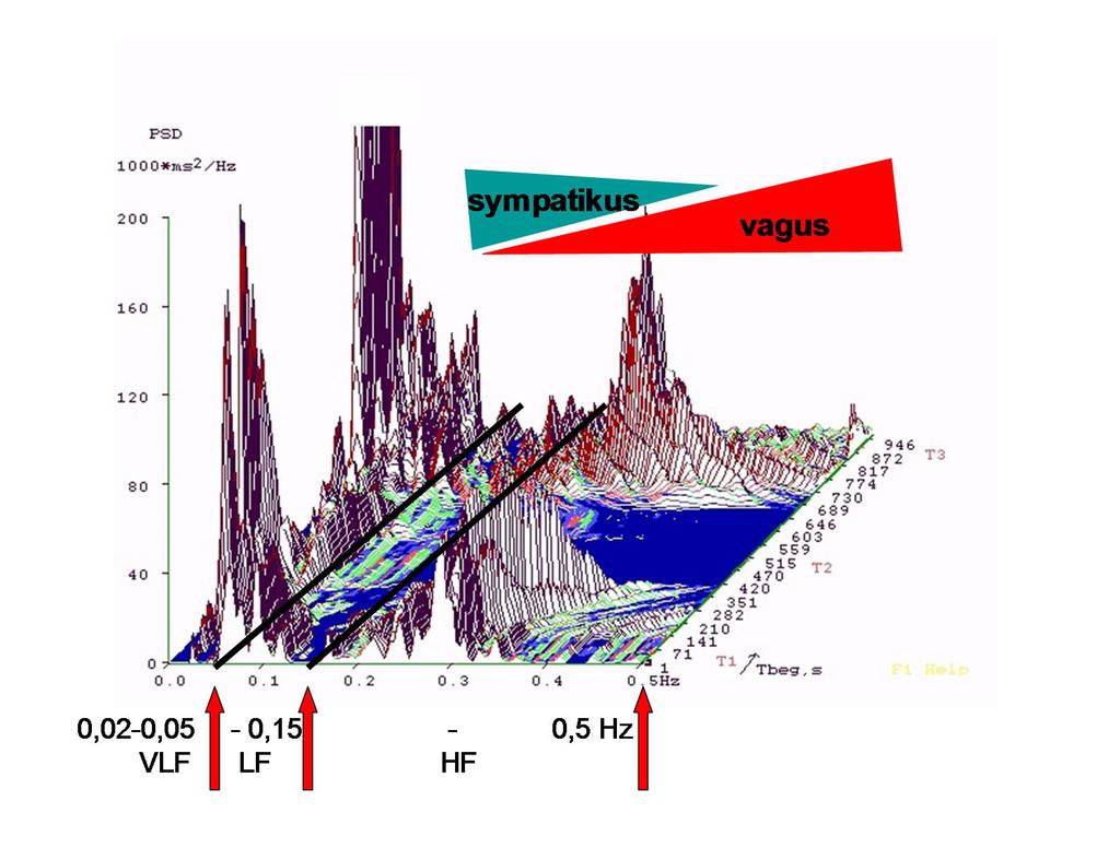 Změny autonomního nervového systému při funkčních poruchách pohybového systému Obrázek 30. Příkladový (ilustrační) graf představující časofrekvenční analýzu variability srdeční frekvence (P.