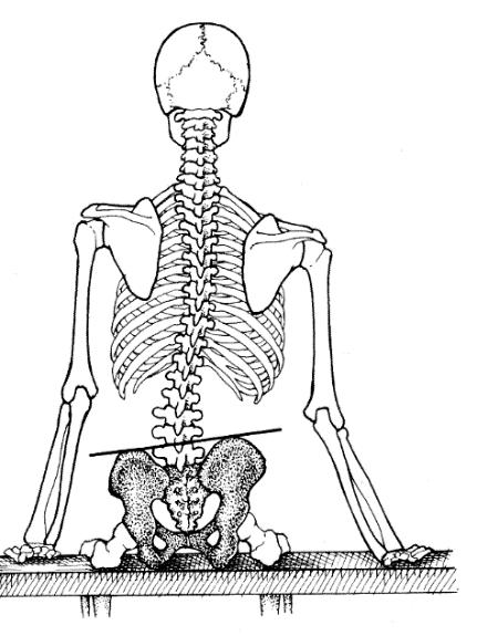 Komplexní kineziologický rozbor pokud jsou gluteální rýhy v nestejné výšce, tedy obvykle gluteální rýha na straně sešikmení je níž a podkolenní rýhy jsou ve stejné výši, zvažuje se strukturální změna