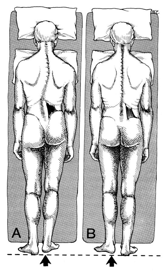 Komplexní kineziologický rozbor Obrázek 18. Postura vleže při zkrácení m. quadratus lumborum (Travell & Simons, 1992).