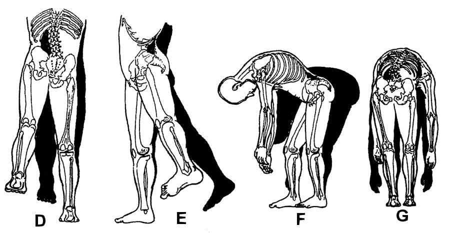 Komplexní kineziologický rozbor Obrázek 19. Ovlivnění postury při jednostranném zkrácení m. quadratus lumborum (vlevo) (Vasiljeva in Liebenson et al.