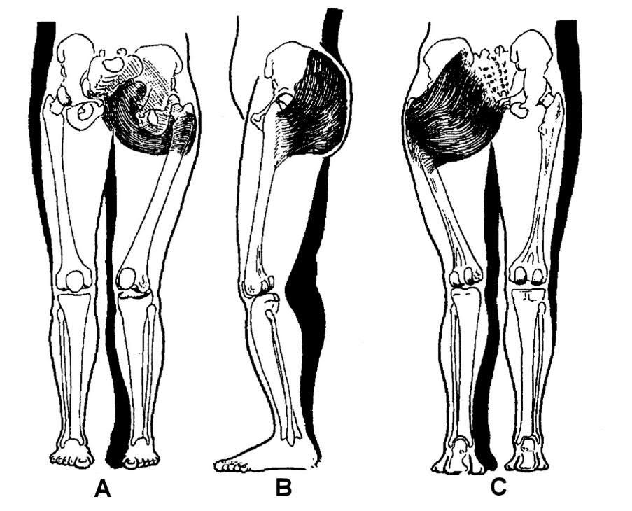 Komplexní kineziologický rozbor Obrázek 23. Dopad jednostranného oslabení m. gluteus maximus (vlevo) na posturu (Vasiljeva in Liebenson et al.