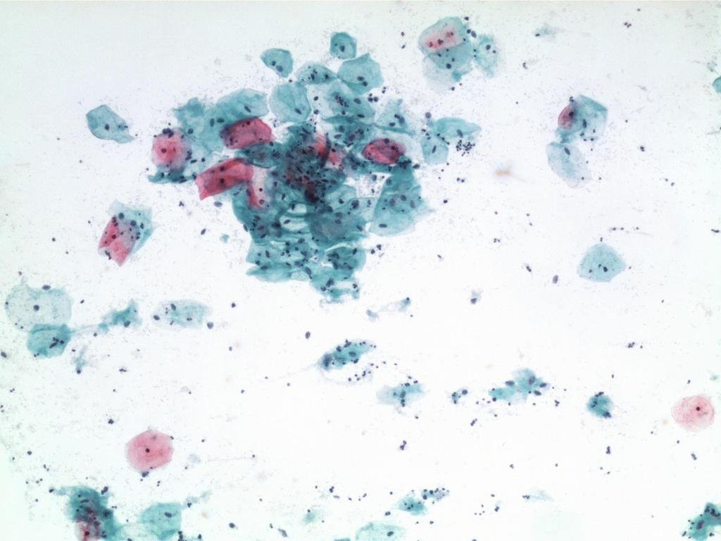 12 let, 5 měsíců. Duben 2014. Polymenorea upravena délka cyklu 28 dnů. Cytogram generačního období. HC- 13.