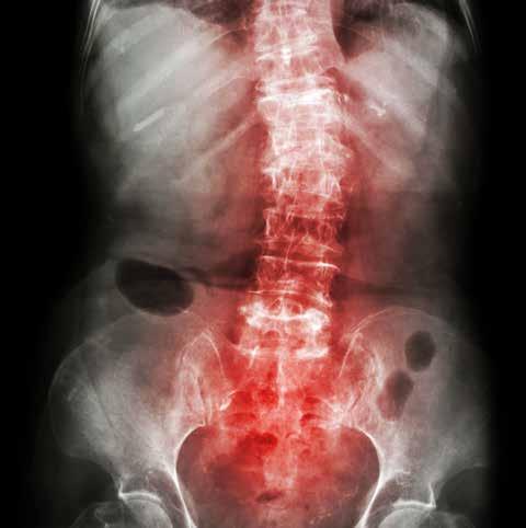 Kazuistiky Spondylóza a spondyloartróza MUDr. Eva Klimešová Revmatolog, Centrum komplexní medicíny, Treboň Muž, 49 let, běžné dětské choroby, časté angíny, v 15 letech tonsilektomie.