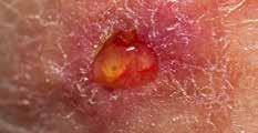 Po operaci abscesu se rozvinula pooperační paréza n. hypoglossus XII. Následně se rozvinula sepse a septický šok. Při sepsi vznikla bilat.