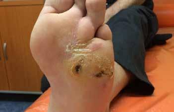 Dosavadní léčba: Vessel Due F, Dobica, Siofor, Thiogamma a Trombex. Kultivací byla zjištěna infekce (Klebsiella sp. a Staphylococcus aureus), již jsme přeléčili antibiotiky dle citlivosti.