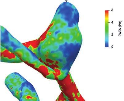 Po přestěhování do areálu na Bukově a vybavení špičkového katetrizačního sálu došlo k prudkému rozvoji neurointervencí na mozkových cévách.