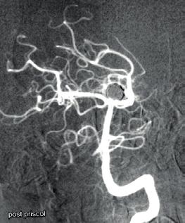 Neurochirurgové chápali výhody takovýchto zákroků pro některé své pacienty a výsledkem byla volba optimálního a šetrného léčebného postupu.