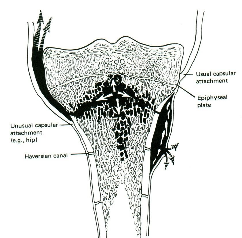 Patologická anatomie hyperémie, otok, hnis porucha cirkulace s tvorbou trombů osteolytická destrukce, sekvestry absces, subperiostální absces