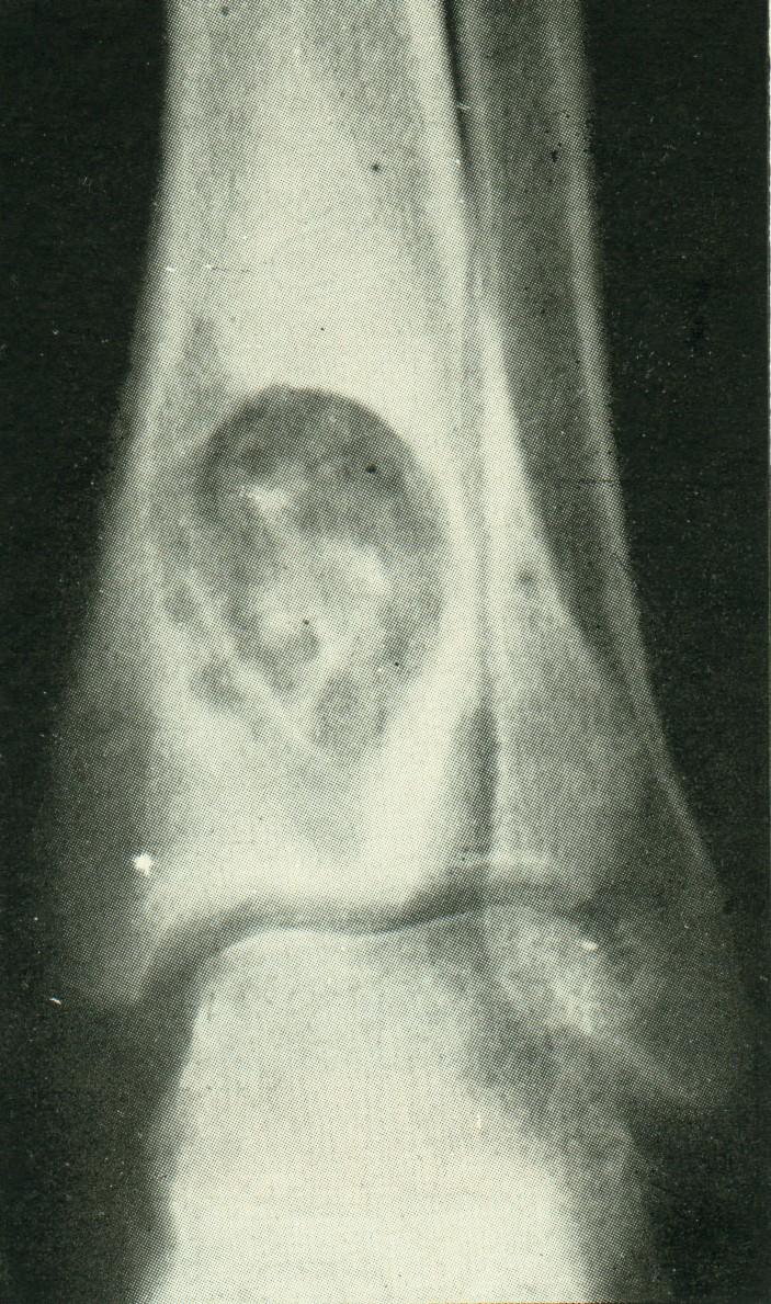 Sekvestr - mrtvý ostrůvek kosti v granulační tkáni nebo v hnisu Pyogenní membrána a sklerotický lem