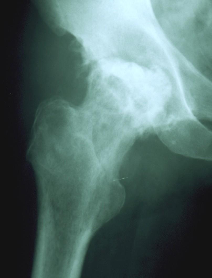 Komplikace pozánětlivá osteoartróza nekróza