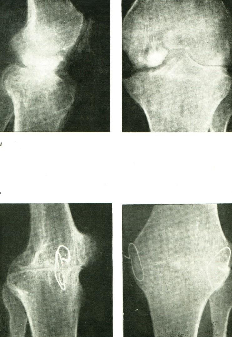 TBC arthritis Antibuberkulotika Klidový režim Dlouhodobá imobilizace Dieta, roborační