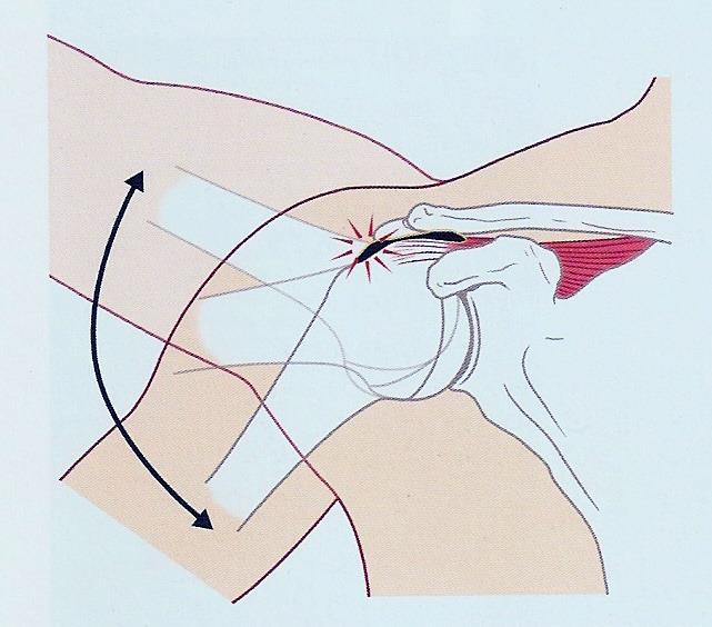 Obrázek 5 - Princip impingement syndromu, útlak šlachy m. supraspinatus při abdukci Převzato z: (Kolář, 2009) 2.5.8 