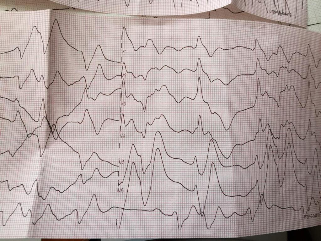 EKG transport