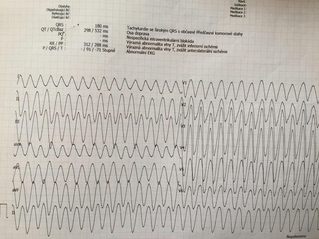 EKG na oddělení na