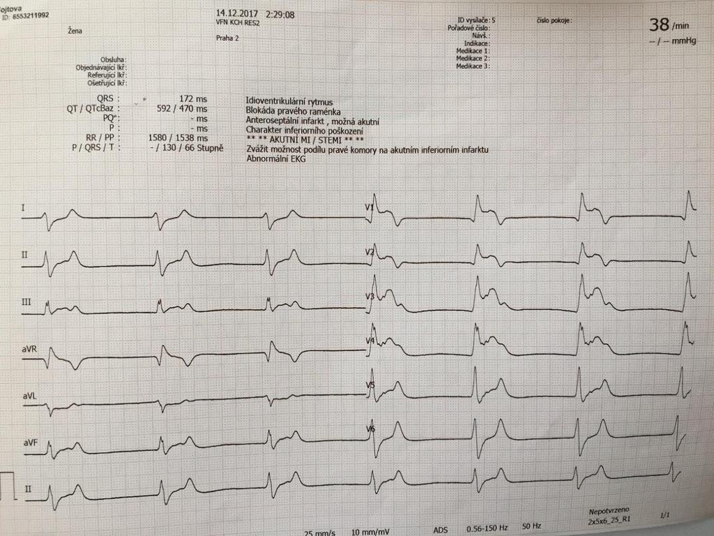 EKG za 2,5