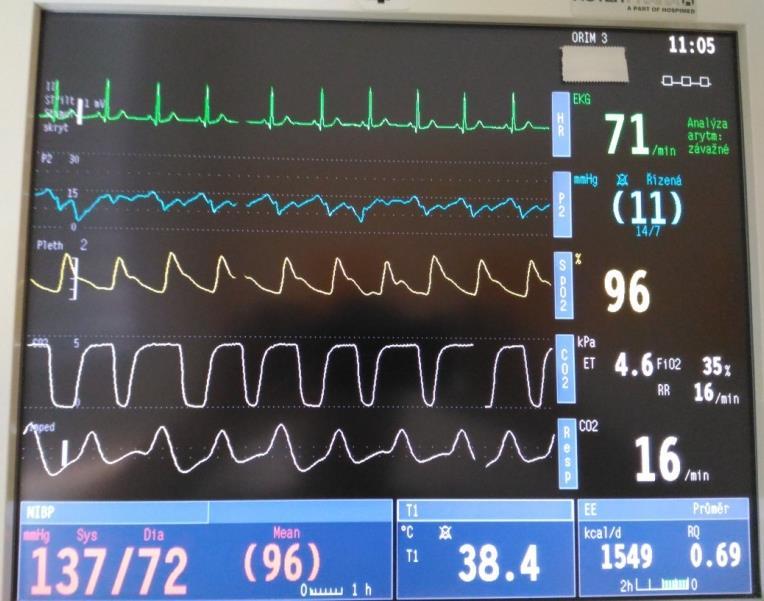 NEPŘÍMÁ KALORIMETRIE stanovení EtCO 2 ve vydechovaném vzduchu a přepočet na povrch těla