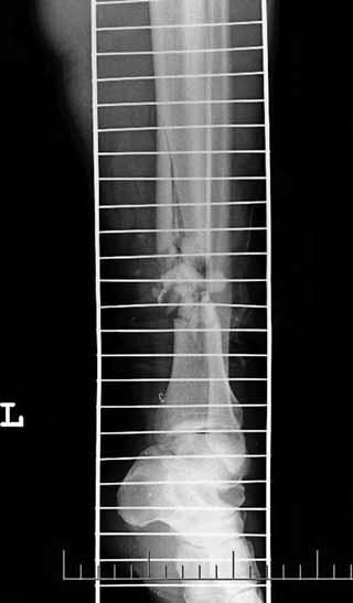 Průměrná doba od osteotomie do začátku distrakce byla 6,1 dní (4 8 dní). Průměrná doba distrakce, tedy doba od osteotomie do dokončení distrakce, byla 74 dní (33 162 dní).