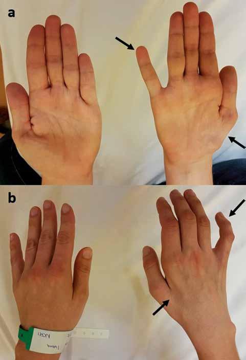 Prehľadové články 47 Obr. 5. Foto ruky pacientky s pravým neurogenním TOS vpravo s obrazem Gilliatt-Sumner hand (hypotrofie intrinsických svalů ruky inervovaných n. medianus a n. ulnaris).