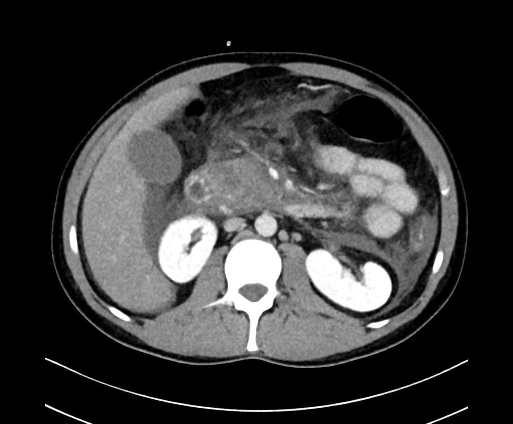 Obrázek 11 - CT vyšetření ze dne 1. 12. 2015 Zdroj - WinMedicalc Výpočet CTSI: stádium E (4 body) + nekróza nad 50 % žlázy (6 bodů) = 10 bodů. Nález odpovídá těžké akutní pankreatitidě. Den 10, 9. 12. 2015: CT vyšetření břicha, po podání KL i.