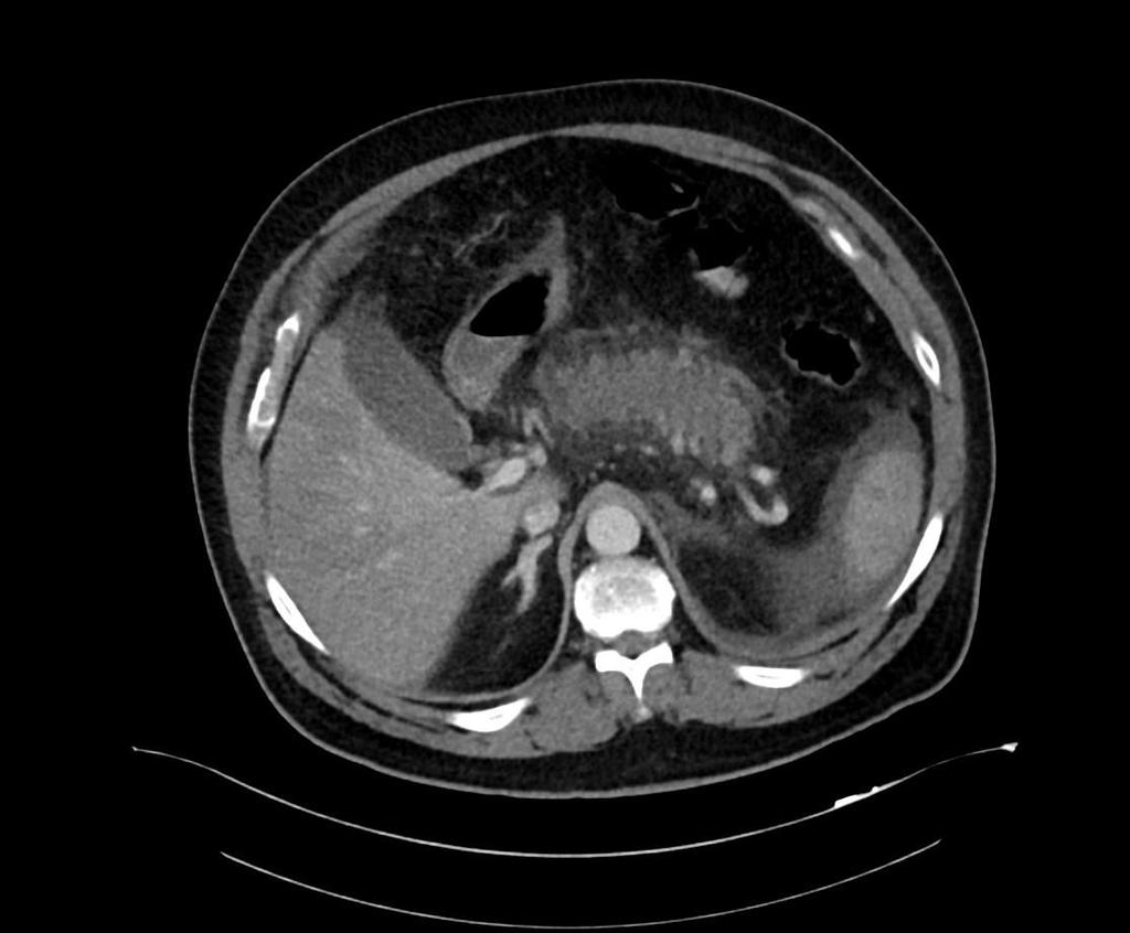 Obrázek 16 - CT vyšetření ze dne 15. 6. 2016 Zdroj - WinMedicalc Výpočet CTSI: stádium E (4 body) + nekróza 30-50 % žlázy (4 bodů) = 8 bodů. Nález odpovídá těžké akutní pankreatitidě. Den 12, 24. 6. 2016: CT vyšetření břicha, po podání KL i.