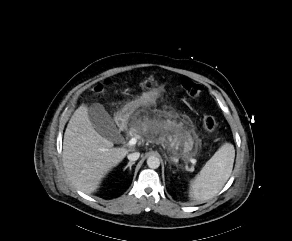 Obrázek 17 - CT vyšetření ze dne 24. 6. 2016 Zdroj - WinMedicalc Výpočet CTSI: stádium E (4 body) + nekróza nad 50 % žlázy (6 bodů) = 10 bodů. Nález odpovídá těžké akutní pankreatitidě. Den 17, 29. 6. 2016: CT vyšetření břicha, po podání KL i.