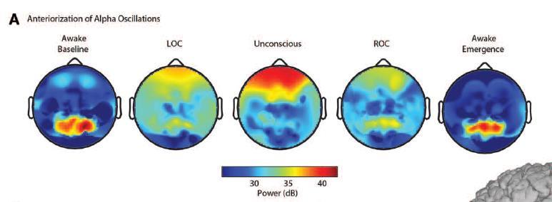 Anteriorizace EEG Purdon PL et al.