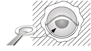 1.5.3. Chirurgická technika. Implantace keratoprotézy AlphaCor probíhá ve dvou fázích. V první fázi vytváříme korneální lamelární kapsu.
