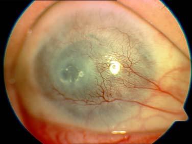 Dvanáct pacientů (80%) podstoupilo před implantací AlphaCor neuspěšnou penetrující keratoplastiku na oku, do kterého byla keratopotéza