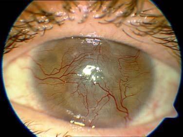 Tři pacienti (20%) neprodělali keratoplastiku na oku před implantací umělé rohovky, ale měli opakovanou transplantaci dárcovské rohovkové