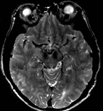 Obr. 1. Parkinsonova nemoc degenerace pars compacta substantiae nigrae projevující se oboustranně splynutím signálu pars reticulata a nucleus ruber; SE sekvence v T2 vážení Obr. 2.
