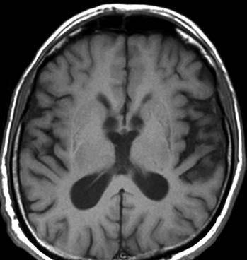 zobrazen. Důležitým faktem pro diferenciální diagnostiku je skutečnost, že signál z bazálních ganglií je u Parkinsonovy nemoci na všech typech vážení MR obrazu v drtivé většině v normě.