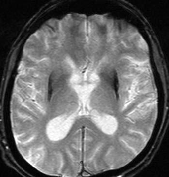 Role neuroradiologa je, krom diferenciální diagnostiky Parkinsonovy nemoci, důležitá rovněž při intervenční léčbě tohoto onemocnění.