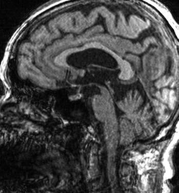 V oblasti substantia nigra jsou pozorovány stejné změny jako u PD, tedy zúžení či vymizení relativně hyperintenzního proužku, odpovídajíc pars compacta substantitae nigrae na T2 vážených obrazech