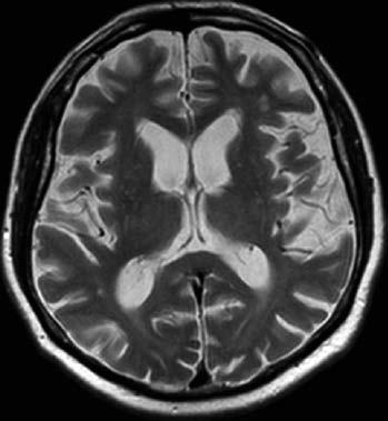 V diferenciální diagnostice mezi PN a různými formami MSA může napomoci i protonová MR spektroskopie, kdy poměr NAA/Cr (N-acetylaspartát ku kreatinu) a NAA/Cho (N-acetylaspartát ku cholinu) bývá u