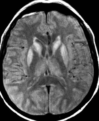 Obr. 9. Vaskulární parkinsonizmus; vícečetné až splývající ischemické změny v bílé hmotě na FLAIR sekvenci Obr. 12. Jacob Creutzfeldova nemoc zvýšení intenzity signálu v oblasti bazálních ganglií Obr.