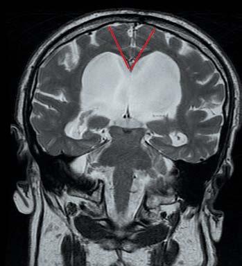 stejném úrovni s tupým úhlem v oblasti corpus callosum Obr. 10. Wilsonova choroba TSE sekvence v T2 vážení Hyperintenzní signál z obou putamin sobené onemocnění.