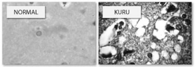 smrtelné neurodegenerativní choroby u lidí např. kuru, Creutzfeld-Jacob, u zvířat např.