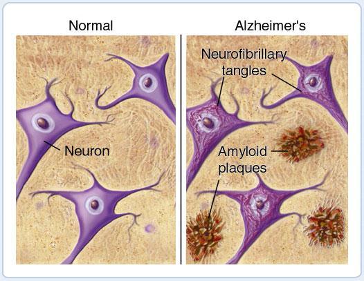 Patologické mechanismy POCD napodobují Alzheimerovu chorobu Alzheimerova ch.