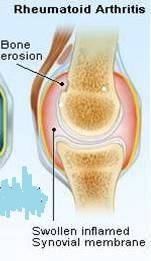 receptor) reumatoidní arthritida Crohnova