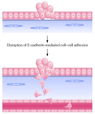 Poruchy adheze zprostředkované E- cadherinem mohou vést k