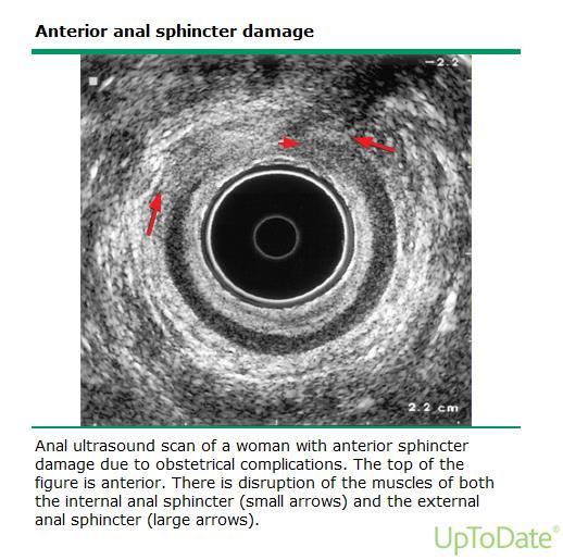 Endoanální ultrasonografie Detailní zhodnocení integrity análních sfinkterů Detekuje strukturální příčiny sfinkterové dysfunkce Vysoké % senzitivity a