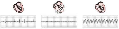 Příloha č. 10 Maligní arytmie EKG záznam Defibrilace je zrušení život ohrožující komorové arytmie elektrickým výbojem.