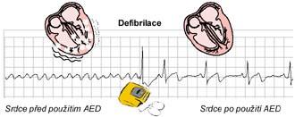 Pokračujeme v resuscitaci podle pokynů AED, dokud nepřijede ZZS, pokud postižený nezačne normálně dýchat nebo do úplného vyčerpání. 20 Obrázek č.