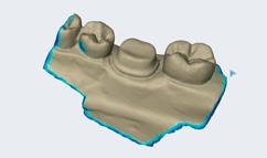 nepřímé bondování Skenujte dentální oblouky s fixními rovnátky. Sledujte postup ošetření a jeho výsledky.